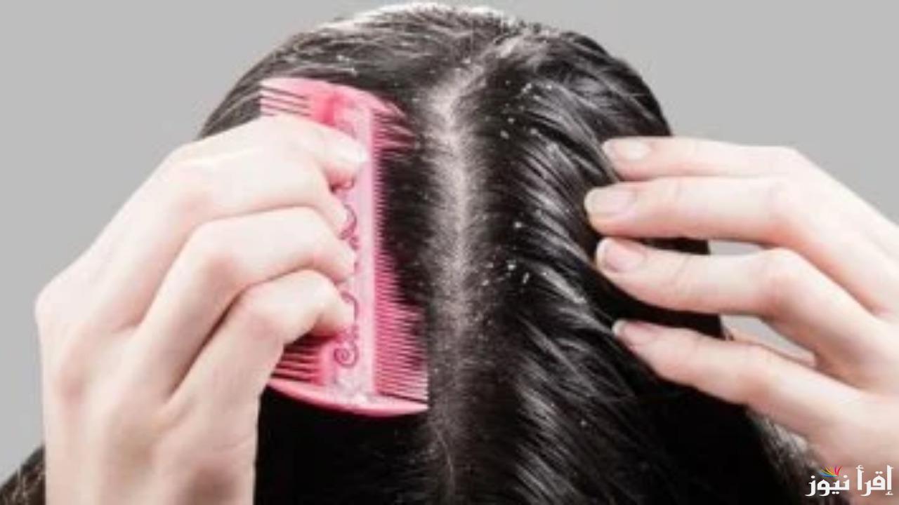 5 طرق بسيطة وسريعة للتخلص من قشرة الرأس في أسرع وقت خاصة في فصل الشتاء البارد